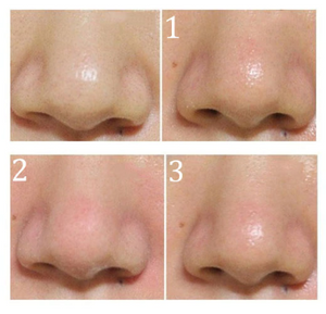 Remove Blackhead Kits